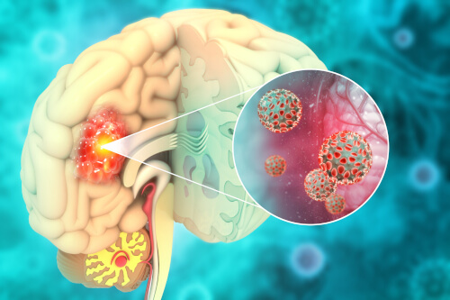 brain tumor representation